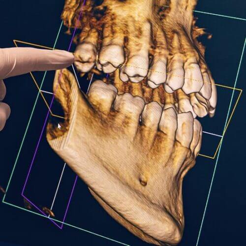 3D rendering of a jaw and teeth
